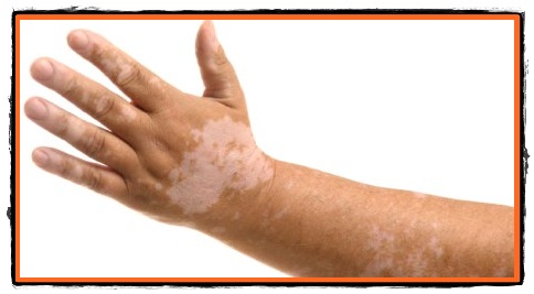 Vitiligo o problema de estetica a pielii